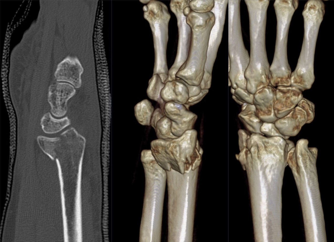 Figure 10. A reverse (dorsal) Barton intra-articular fracture on sagittal CT and 3D reconstructions, the kind of articular detail CT adds to plain films. Hellerhoff, via Wikimedia Commons, CC BY-SA 4.0.