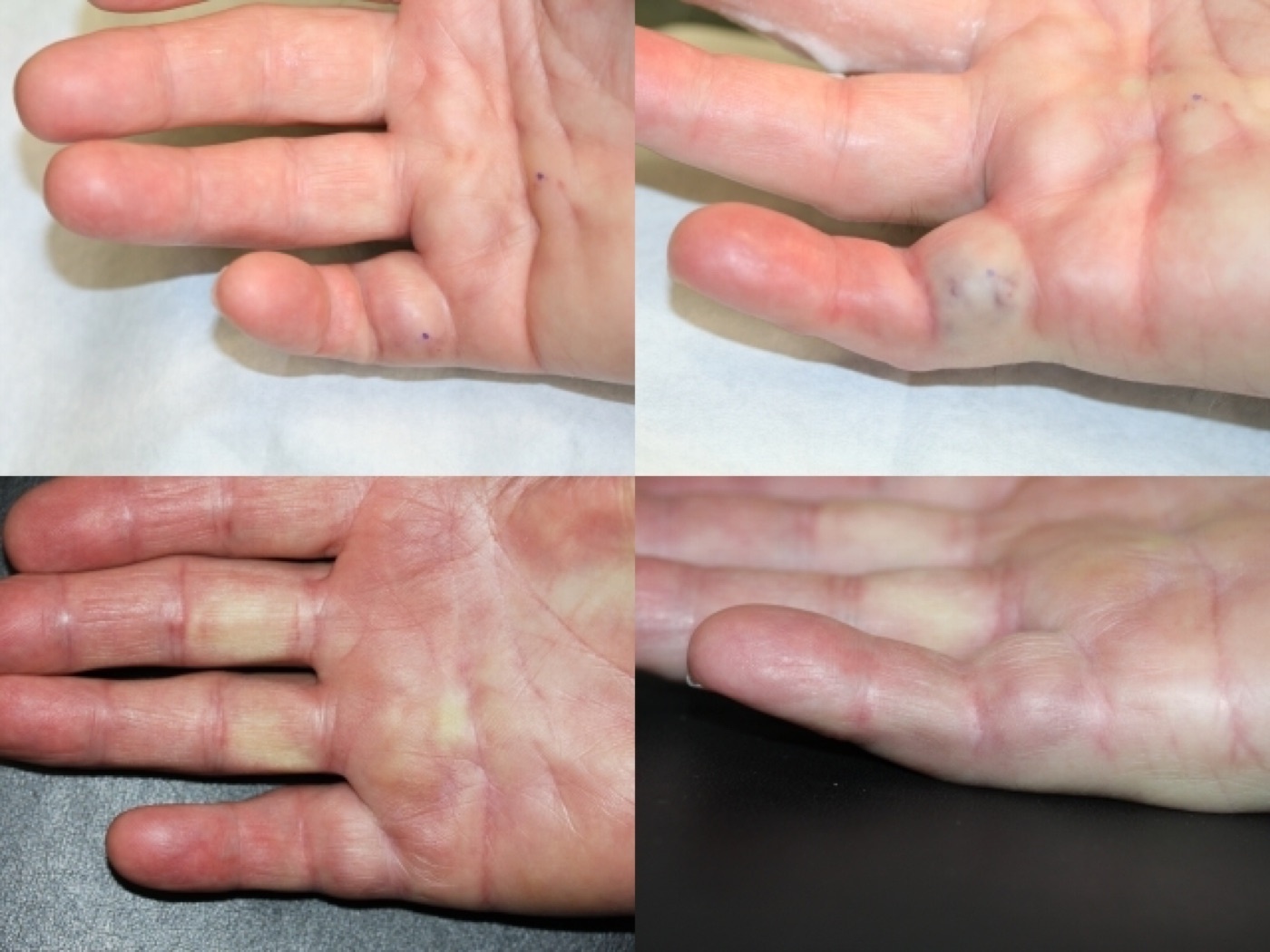 Figure 9. Collagenase (Xiaflex) treatment of a Dupuytren cord: before, next-day ecchymosis after manipulation, and after. Source: Denkler, via Wikimedia Commons (public domain).
