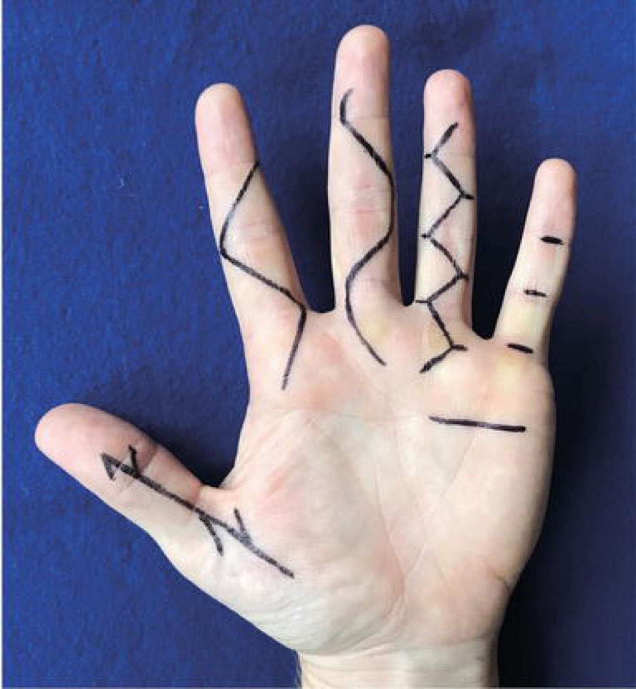 Figure 10. Incision and closure options for Dupuytren surgery - longitudinal with Z-plasty, Brunner zig-zag, V-Y, and transverse (McCash open-palm). From Johnson, Pavano & Rodner (2018), IntechOpen, CC BY 3.0.