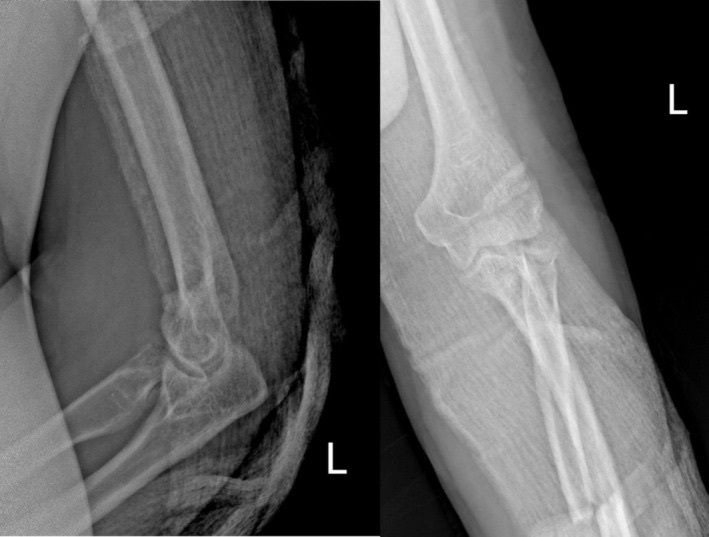 Figure 10. Associated coronoid-process and radial-head fractures, the bony components of a terrible-triad pattern. From Clinical Case Reports (2025), PMC12578567, CC BY 4.0.