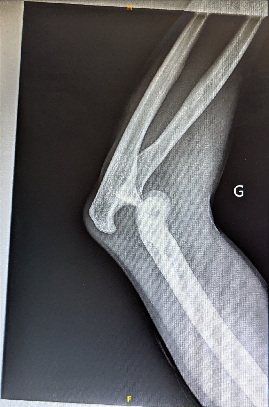 Figure 11. Posterior dislocation of the elbow without fracture (a simple dislocation), lateral radiograph. Source: Flibust1er, via Wikimedia Commons, CC0 1.0.
