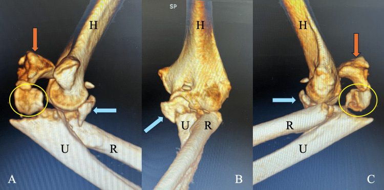 Figure 12. Terrible triad on 3D CT: a radial-head fracture (circle) and a coronoid fracture (arrow) with the dislocation, here also with an olecranon fracture. From Cureus (2026), PMC12999191, CC BY 4.0.