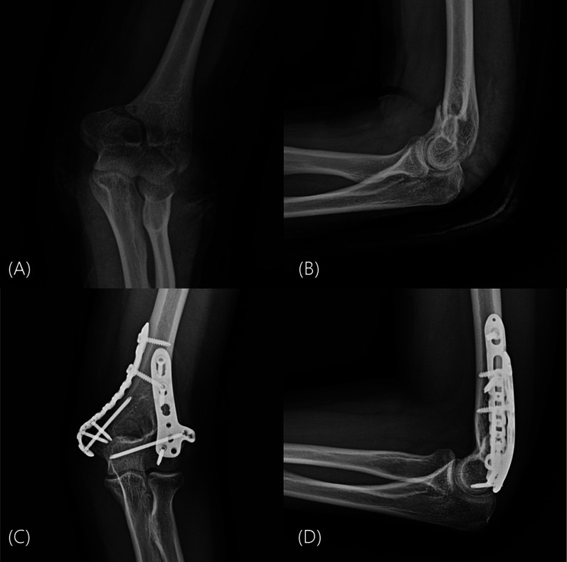 Figure 3. A distal humerus fracture before and after dual-plate (orthogonal) fixation with medial and posterolateral plates. From Lee et al. (2026), J Orthop Traumatol, PMC13287183, CC BY 4.0.