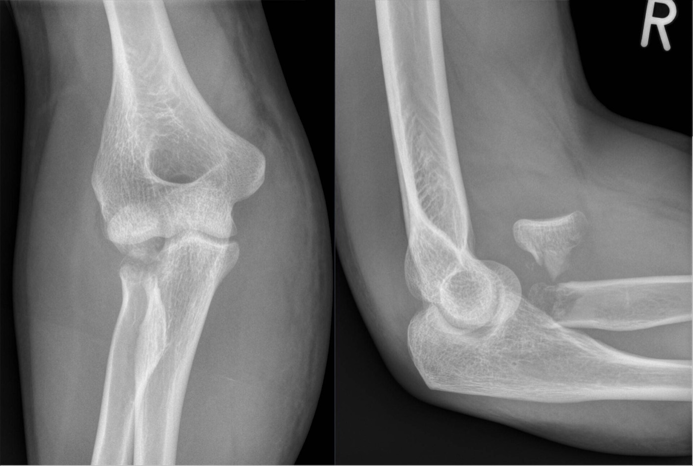 Figure 8. A displaced, rotated radial-head fracture (Mason III), AP and lateral radiographs. Source: Hellerhoff, via Wikimedia Commons, CC BY-SA 4.0.