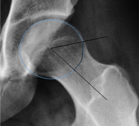Alpha angle (45° Dunn view). A best-fit circle on the femoral head; the alpha angle lies between the neck axis and the line to the point where the head contour exits the circle. From Ruiz Santiago et al., Radiol Res Pract 2016;2016:6369237, Fig. 6g (CC BY 4.0).