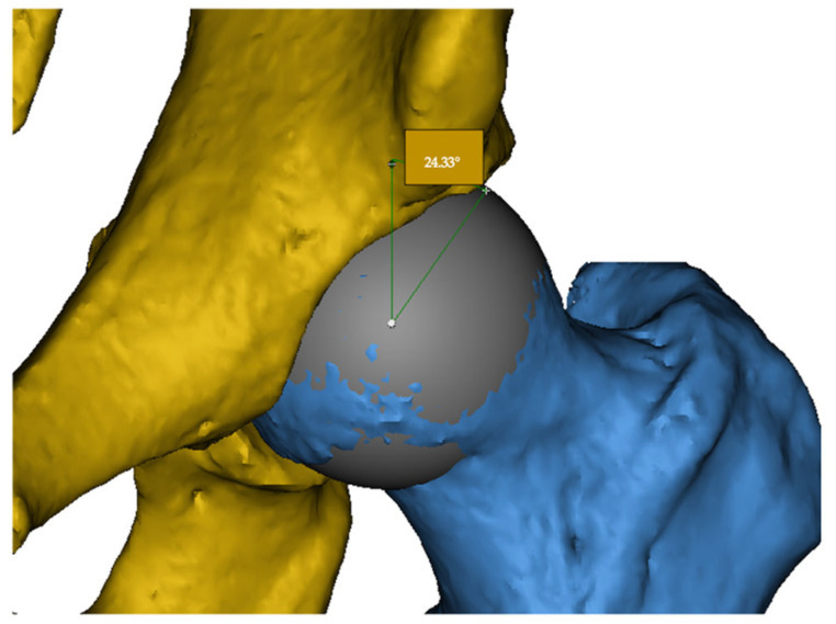 3-D CT reconstruction of the hip. Surface rendering of the acetabulum (yellow) and femur (blue) with a best-fit sphere on the head and the lateral centre-edge angle measured - the modality that best displays bony morphology and version. İsmailoğlu et al., J Clin Med 2025;14:7220, Fig. 1 (CC BY 4.0).
