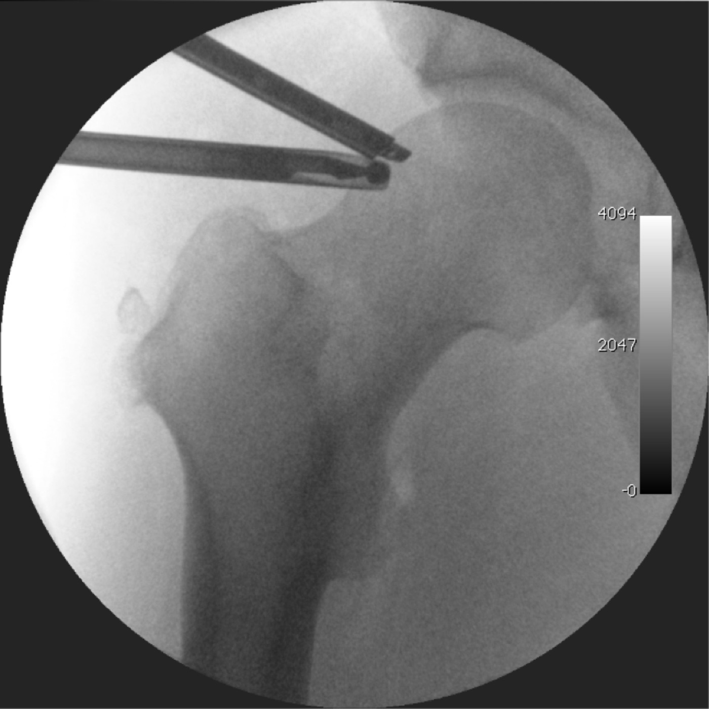 Arthroscopic cam resection. Intra-operative fluoroscopy during arthroscopic osteochondroplasty: the arthroscope (above) and the high-speed burr (below) at the femoral head-neck junction. Gileshugo, Wikimedia Commons, CC BY-SA 3.0.