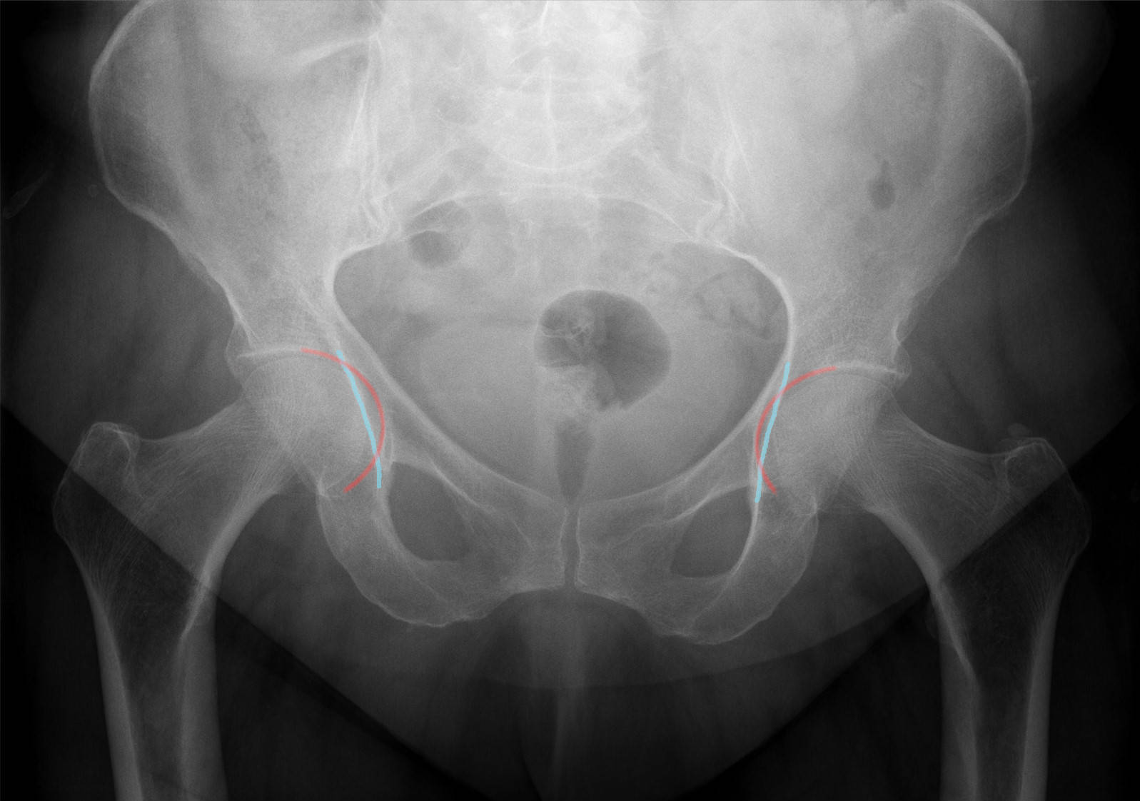 Coxa profunda (annotated). AP pelvis with the acetabular floor overlapping the ilioischial line bilaterally - the radiographic coxa profunda sign of a deep socket. Hellerhoff, Wikimedia Commons, CC BY-SA 4.0.