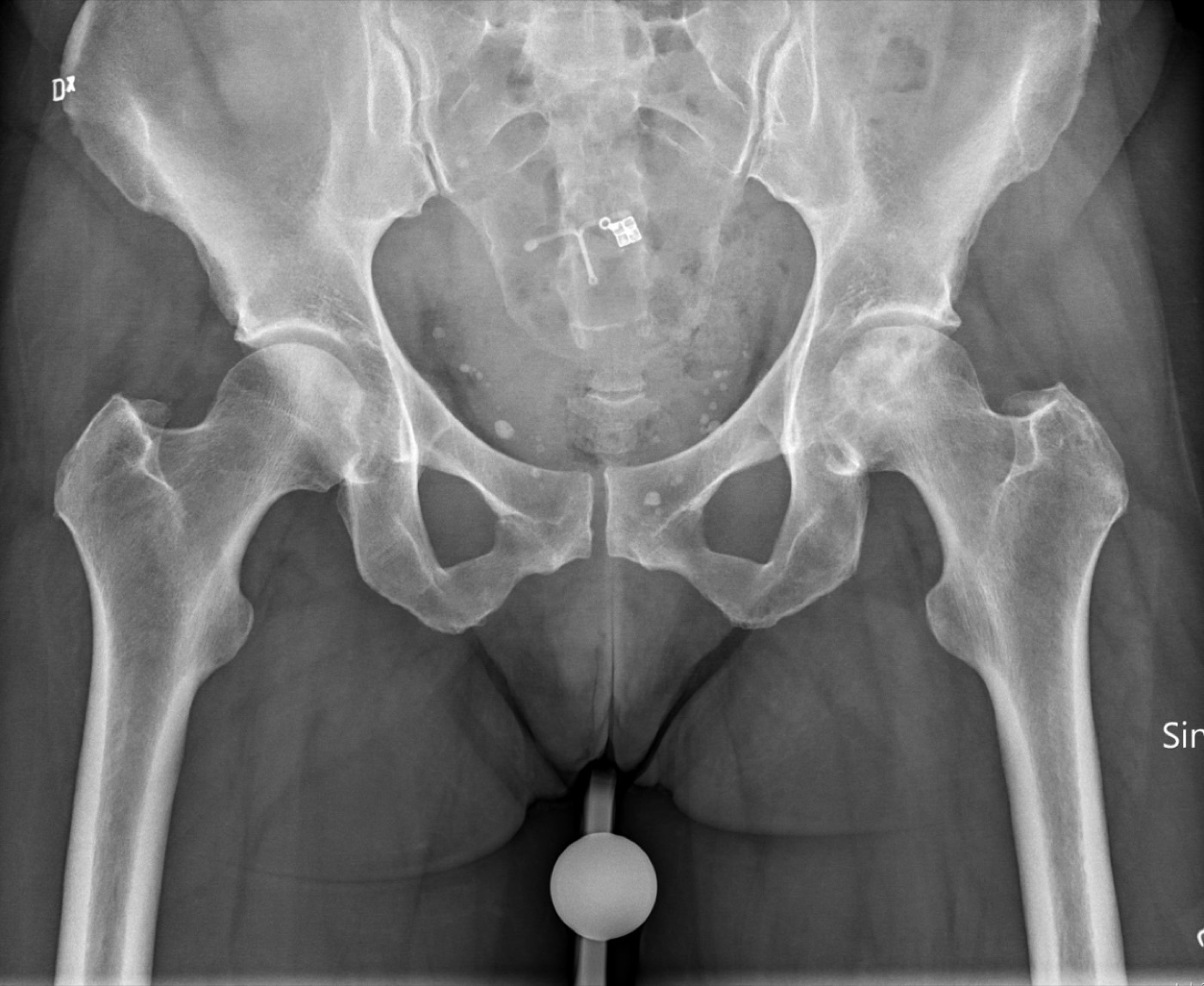 Figure 11. Avascular necrosis of the femoral head on radiograph. Mikael Häggström, CC0, via Wikimedia Commons.