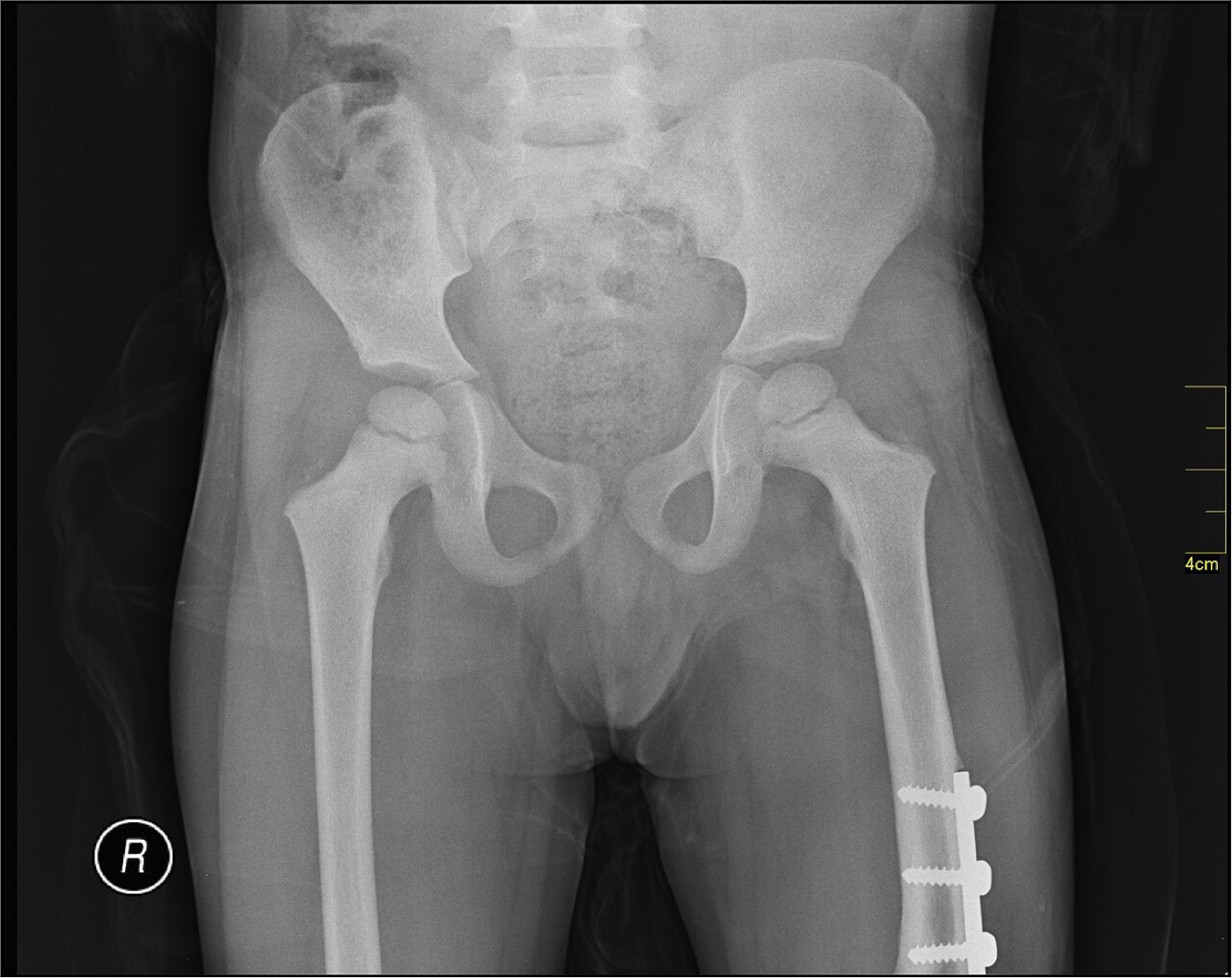 Figure 16. Paediatric femoral shaft fracture stabilised with a lateral (submuscular) bridge plate and screws. Image by Nevit Dilmen, CC BY-SA 3.0, via Wikimedia Commons.
