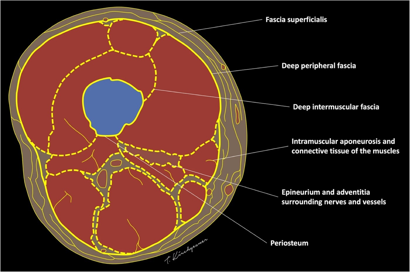 Figure 3. Transverse section of the thigh: the femur lies within the three muscle compartments, bounded by the fascial and intermuscular planes. Illustration by Thomas Kirchgesner, CC BY 4.0, via Wikimedia Commons.