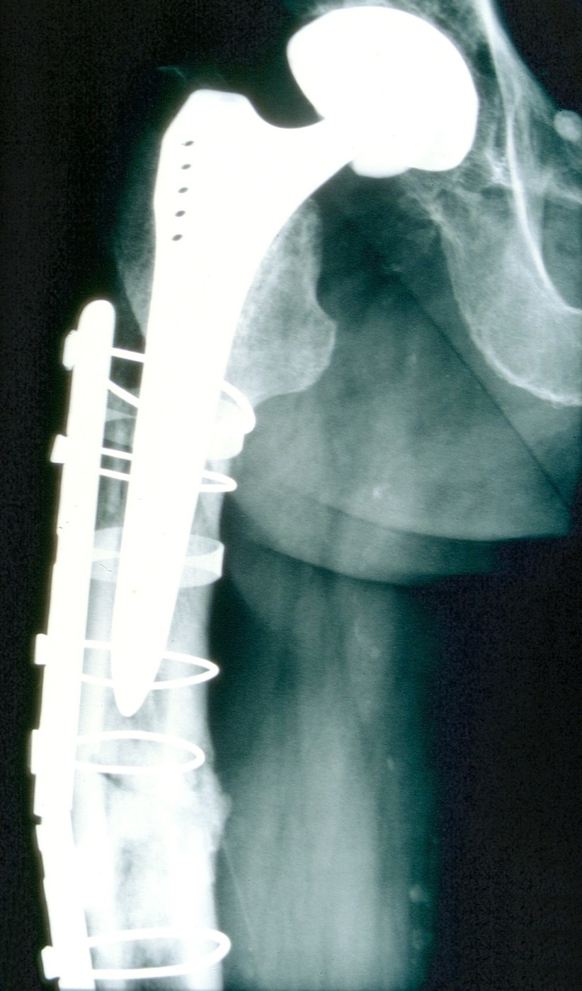 Figure 10. Periprosthetic femoral shaft fracture about a cemented stem, stabilised with a lateral plate, screws, and cerclage cables. Image by Mehlauge, CC BY-SA 3.0, via Wikimedia Commons.