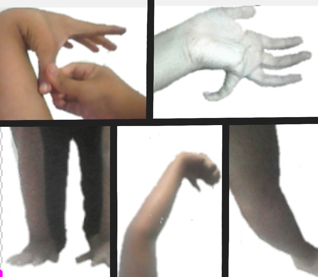 The Beighton manoeuvres in a person scoring 9/9: thumb-to-forearm, little-finger hyperextension, elbow and knee hyperextension, and palms flat to the floor. (Rollcloud, Wikimedia Commons; CC0.)