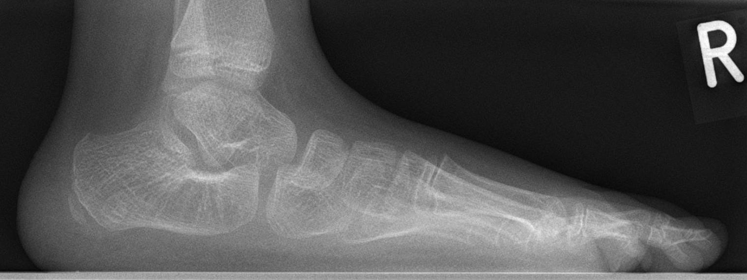 Weight-bearing lateral radiograph of a child’s foot with pes planus: a plantar-flexed talus, low calcaneal pitch and a flattened arch. (Hellerhoff, Wikimedia Commons; CC BY-SA 4.0.)