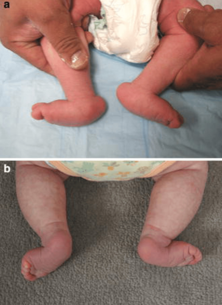 Clinical appearance of bilateral congenital vertical talus: the convex plantar surface (“rocker-bottom” foot) with a prominent talar head. (Cureus 2023;15(9):e45867; CC BY 4.0.)