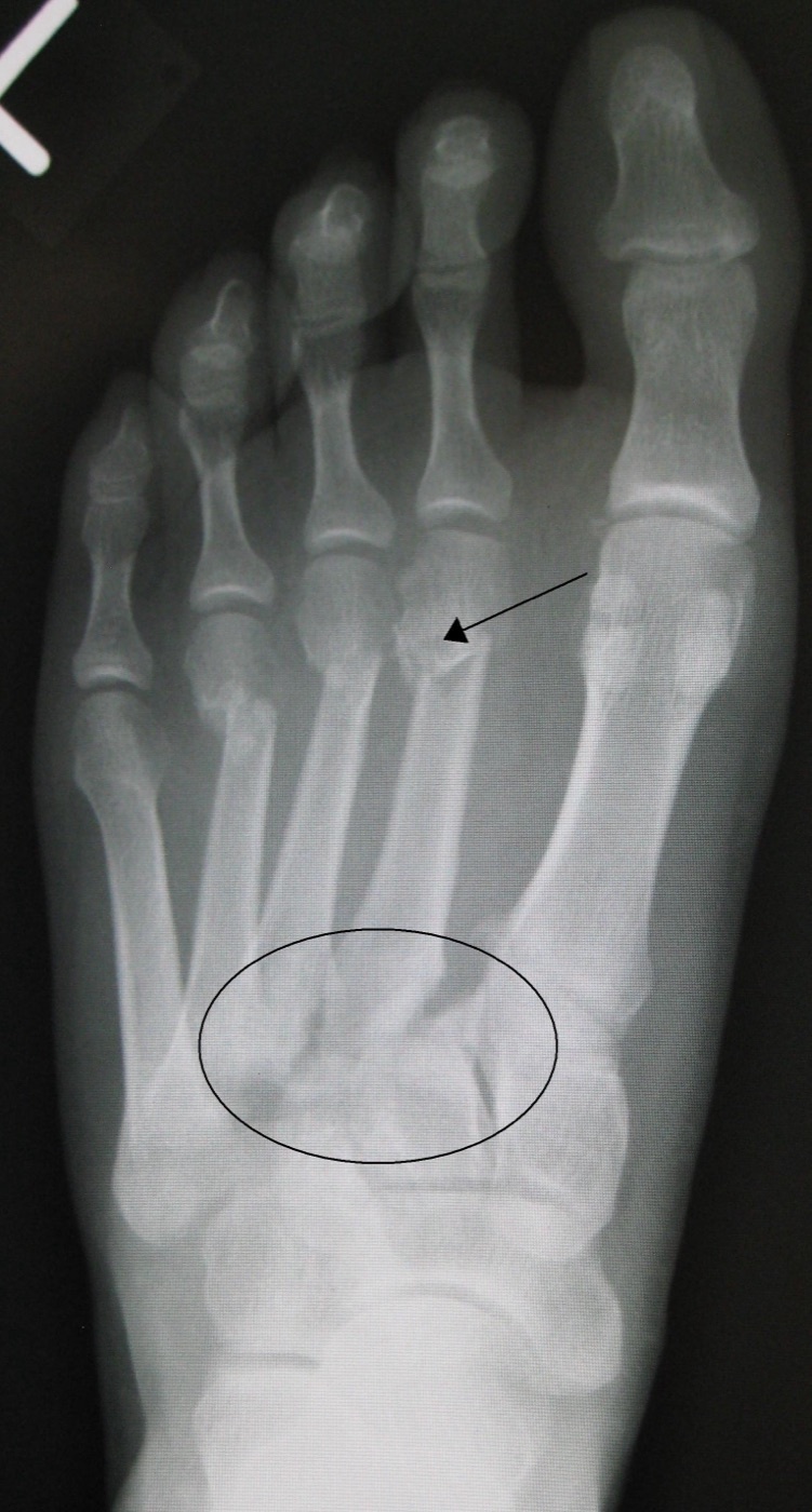 Figure 10. AP radiograph of a Lisfranc (tarsometatarsal) injury with malalignment at the base of the second metatarsal. James Heilman, MD, CC BY 3.0, via Wikimedia Commons.
