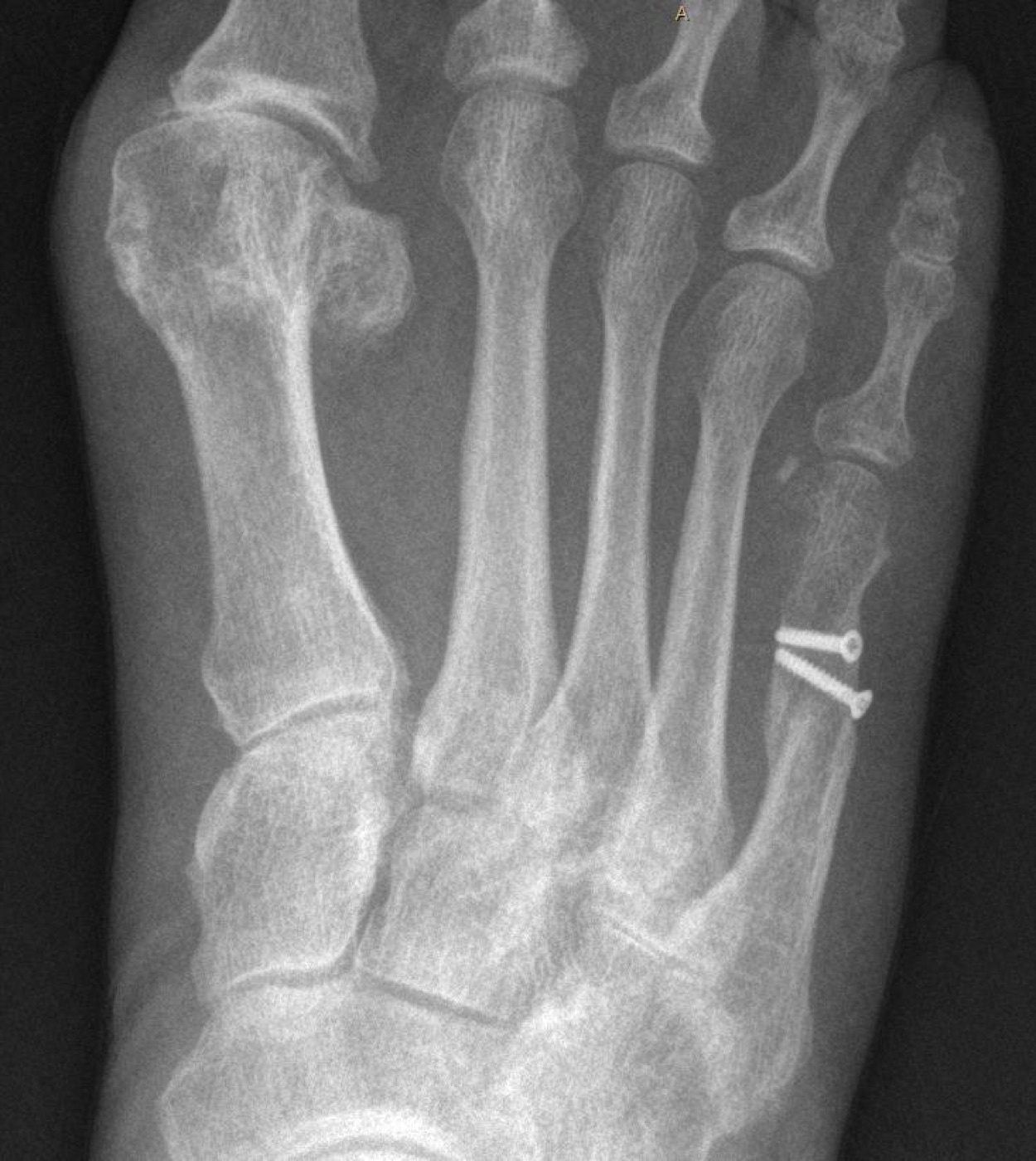 Figure 16. Postoperative radiograph after internal fixation of a fifth-metatarsal fracture with two screws. Jmarchn, CC BY-SA 3.0, via Wikimedia Commons.