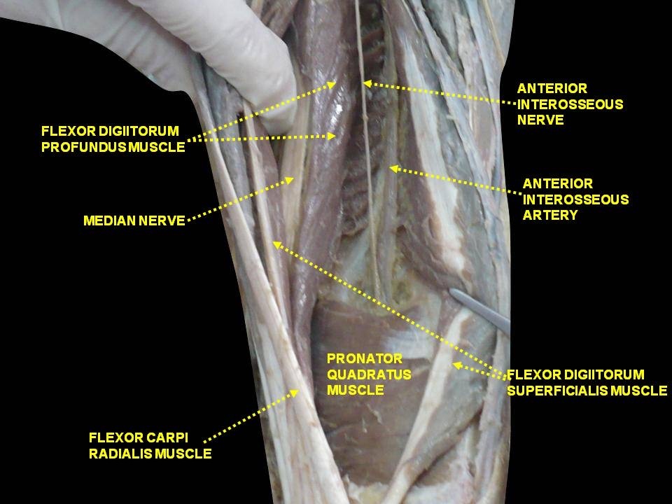 Figure 6. Median nerve in the forearm giving off the anterior interosseous nerve, which descends with the anterior interosseous artery on the interosseous membrane between flexor digitorum profundus and flexor pollicis longus. Anatomist90, CC BY-SA 4.0, via Wikimedia Commons.