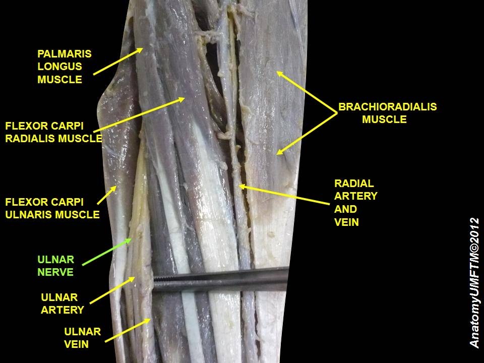 Figure 8. Ulnar neurovascular bundle in the forearm: the ulnar nerve and ulnar artery running deep to flexor carpi ulnaris (the interval between FCU and FDP), with the radial artery shown radially. Anatomist90, CC BY-SA 3.0, via Wikimedia Commons.