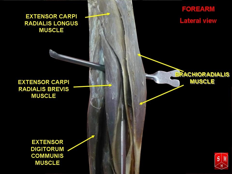 Figure 16. Lateral view of the forearm showing the mobile wad (brachioradialis, extensor carpi radialis longus and brevis), which is mobilised and retracted to develop the Henry plane. Anatomist90, CC BY-SA 3.0, via Wikimedia Commons.