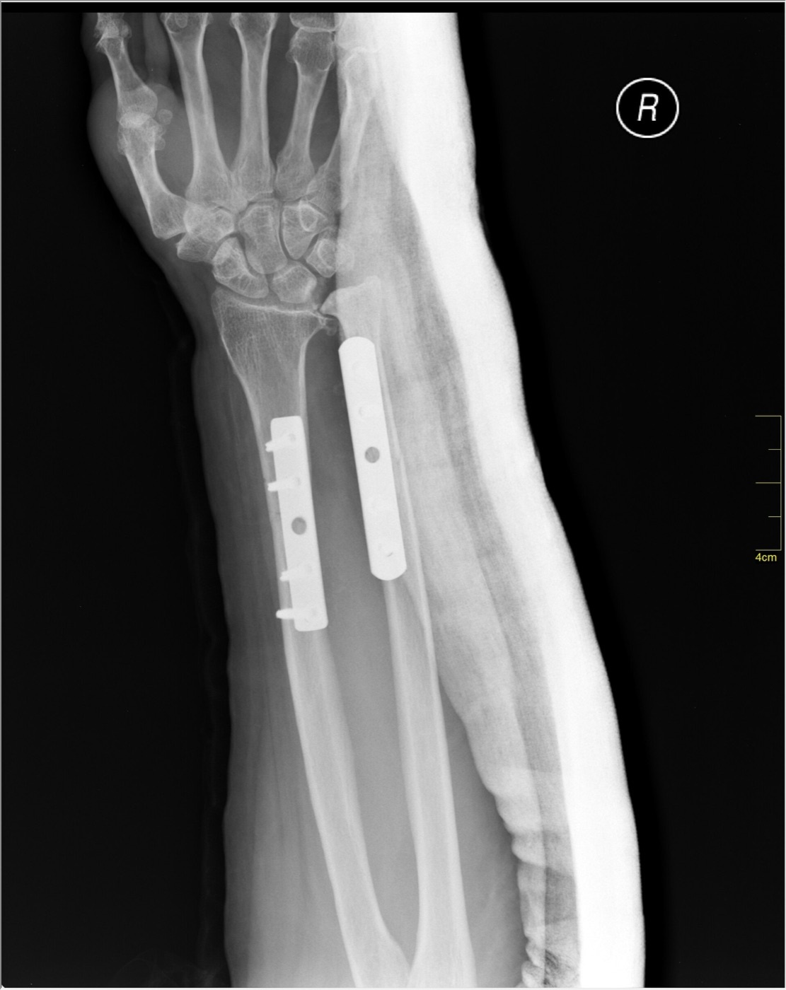 Figure 9. A both-bone forearm fracture after open reduction and internal fixation with plates and screws on both the radius and the ulna. Nevit Dilmen, CC BY-SA 3.0, via Wikimedia Commons.