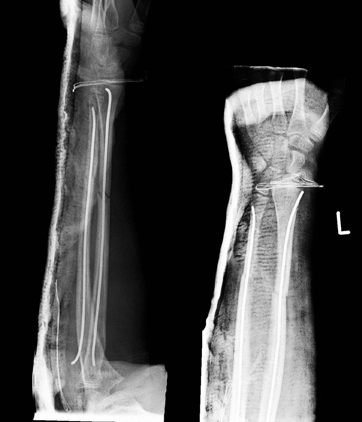 Figure 11. The same forearm stabilised with elastic intramedullary nails, the elastic-nail technique that is standard in children. Thomas Zimmermann (THWZ), CC BY-SA 3.0 DE, via Wikimedia Commons.