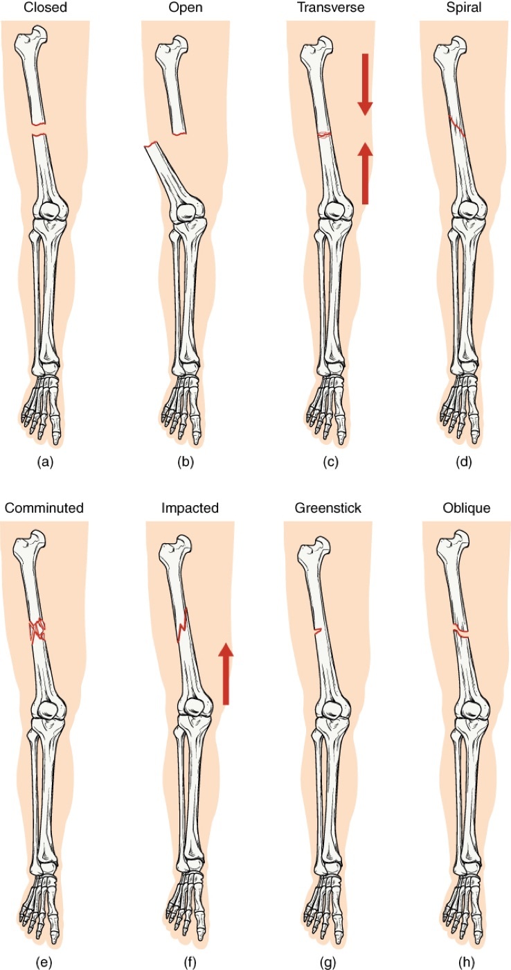 Figure 4. Fracture patterns and the corresponding loading: closed/open, transverse, spiral, comminuted, impacted, greenstick and oblique. Source: OpenStax College, Anatomy & Physiology, via Wikimedia Commons, CC BY 4.0.