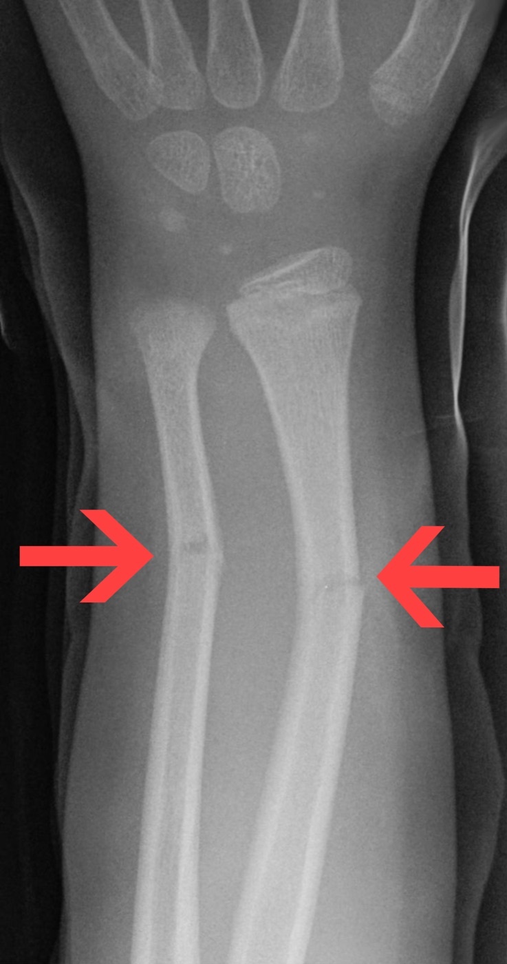 Figure 8. Greenstick fractures of the paediatric radius and ulna (incomplete fracture). Source: Hellerhoff, via Wikimedia Commons, CC BY-SA 3.0.
