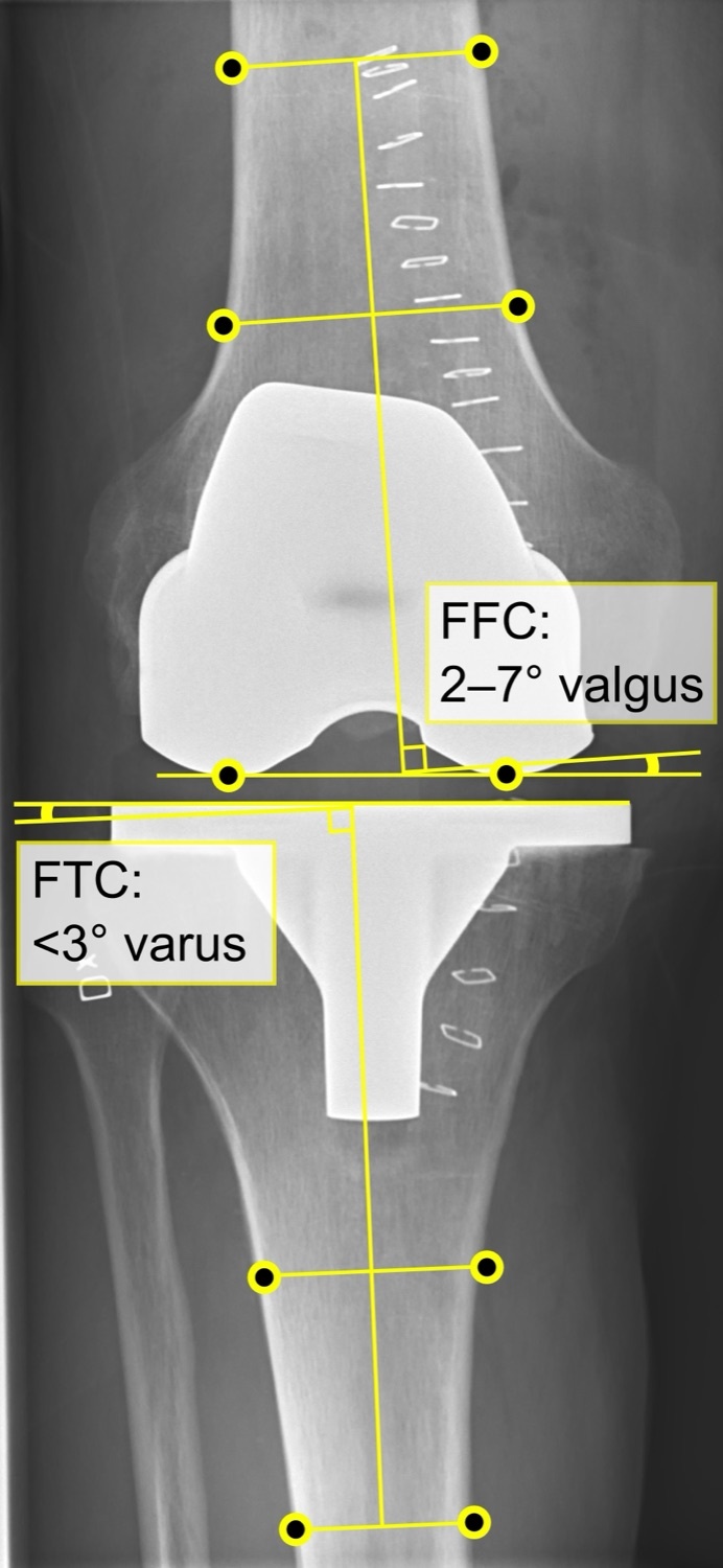 Total-knee-arthroplasty alignment. Long-leg AP radiograph of a normal TKA annotated with the mechanical axis and the femoral (FFC) and tibial (FTC) component angles. Mikael Häggström, CC0 1.0, via Wikimedia Commons.