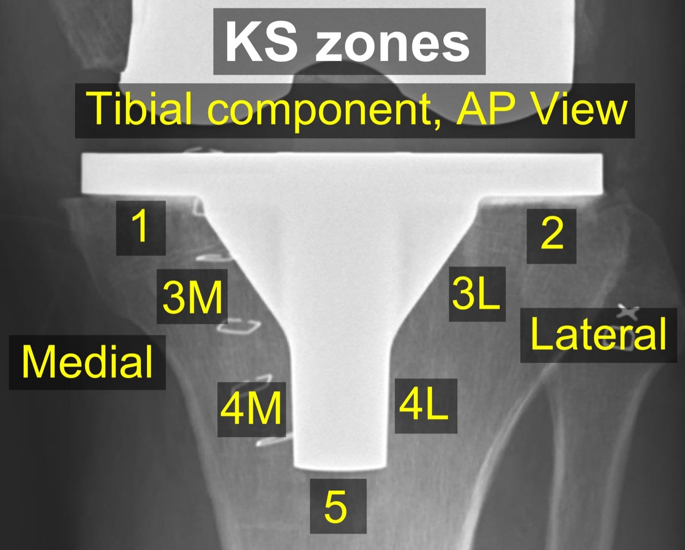 Knee Society radiographic zones. AP radiograph of a TKA tibial component with the 2015 Knee Society zones used to document radiolucent lines and loosening. Mikael Häggström, CC0 1.0, via Wikimedia Commons.