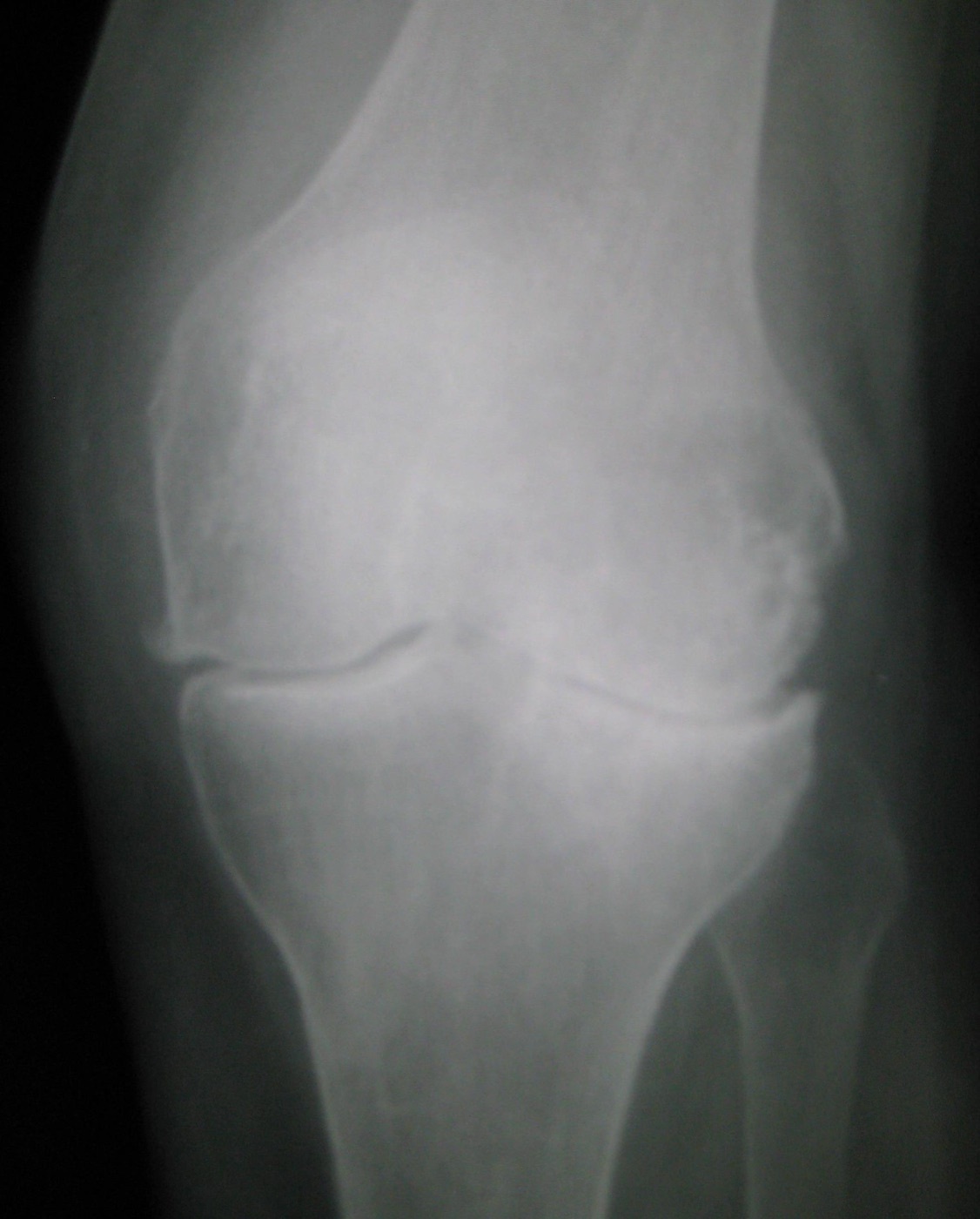 Tricompartmental knee osteoarthritis. AP radiograph of the left knee: marginal osteophytes, joint-space narrowing and subchondral sclerosis. James Heilman, MD, CC BY-SA 3.0, via Wikimedia Commons.