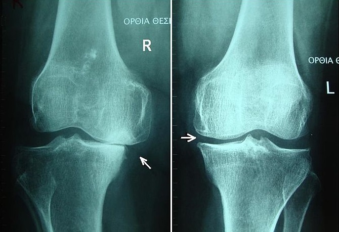 Knee osteoarthritis, radiographic grades II and III. Bilateral standing AP radiographs with arrows on the narrowed joint spaces, illustrating progressive severity. Charalampos Gkouvas (Harrygouvas), CC BY-SA 3.0, via Wikimedia Commons.