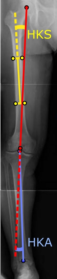 Lower-limb alignment (HKA and HKS angles). Long-leg standing radiograph annotated with the hip-knee-ankle (blue) and hip-knee-shaft (yellow) axes used to plan realignment. Mikael Häggström, CC BY 2.0, via Wikimedia Commons.