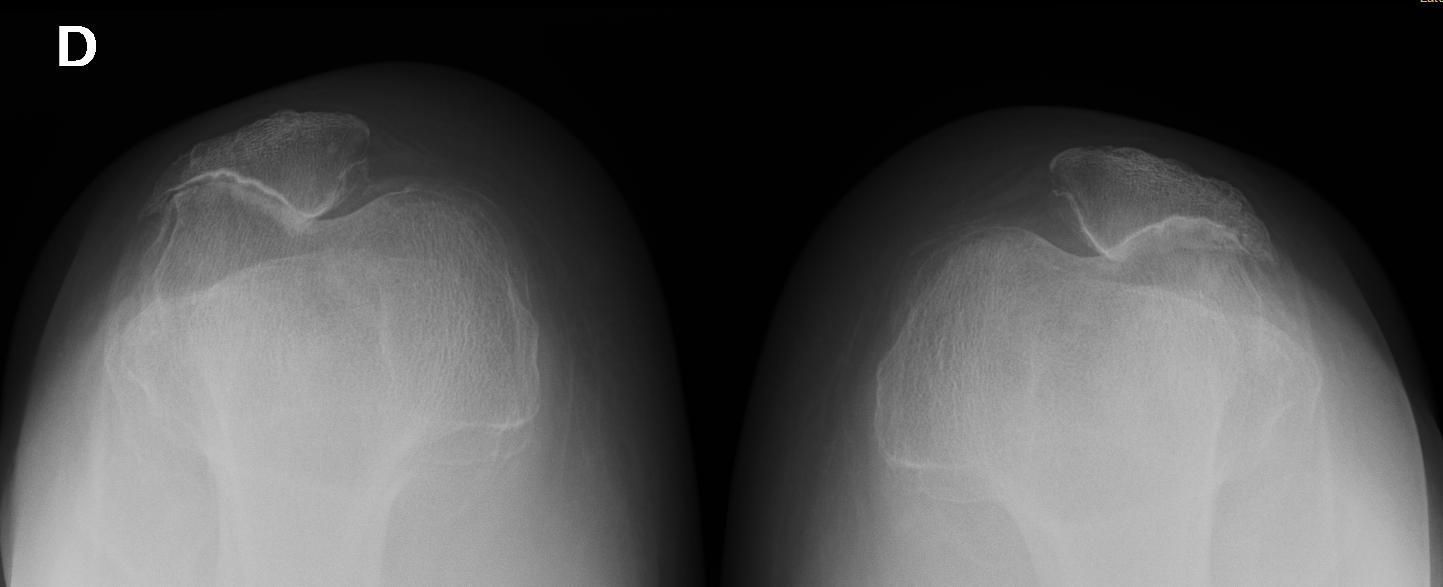 Severe patellofemoral osteoarthritis (axial / skyline view). Lateral-facet joint-space loss, osteophytes and subluxation of both patellae. Jmarchn, CC BY 4.0, via Wikimedia Commons.