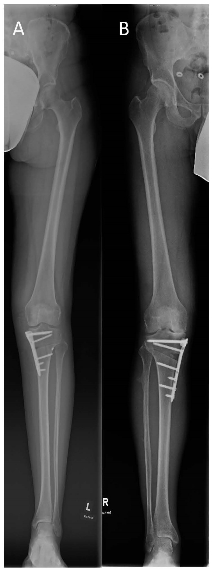 Medial open-wedge high tibial osteotomy. Post-operative full-length radiographs with angular-stable plates (LOQTEQ® and TomoFix™) and the corrected mechanical axis. Park et al., J Pers Med 2023;13(3):472, Fig. 2, CC BY 4.0.