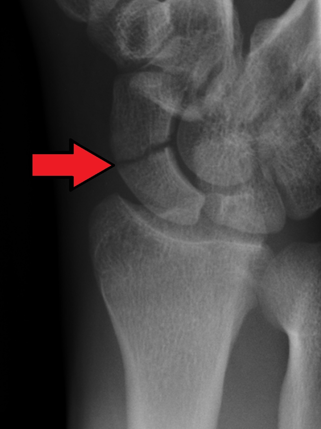 Figure 14. Radiograph of a scaphoid waist fracture. Gilo1969, CC BY 3.0, via Wikimedia Commons.