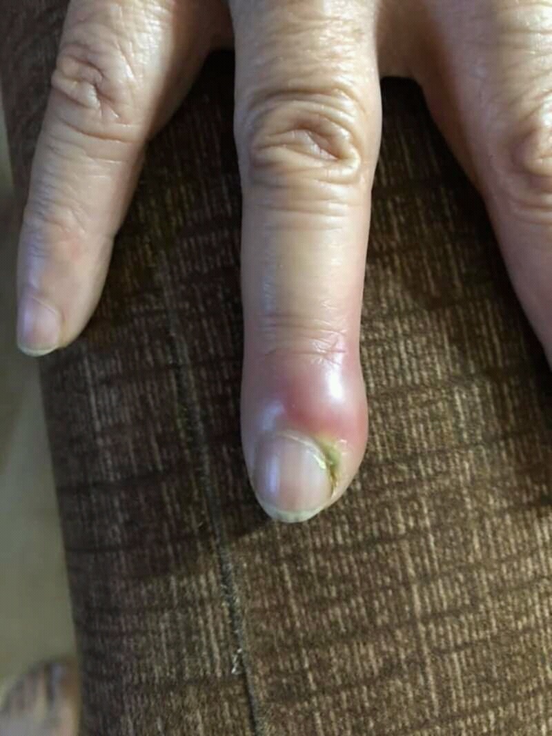 Figure 16. Acute paronychia: infection of the nail fold. Chris Craig (public domain), via Wikimedia Commons.