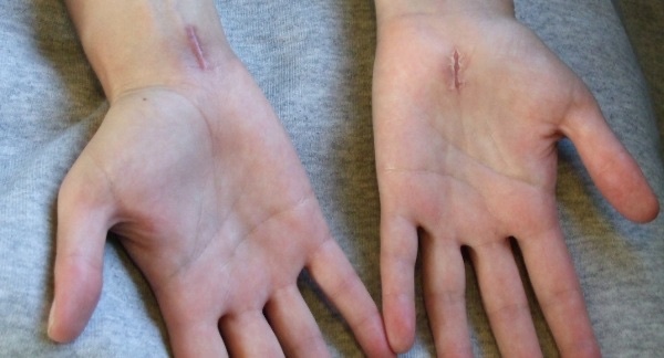 Figure 17. Healed open carpal-tunnel-release scars in the palm, placed ulnar to the thenar crease. HenrykGerlach, CC BY-SA 3.0, via Wikimedia Commons.
