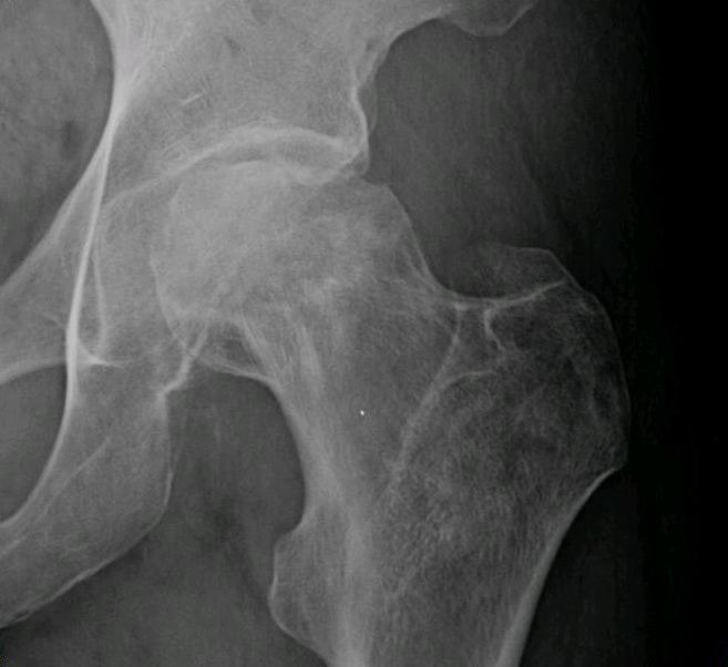 Figure 14. Avascular necrosis of the femoral head: radiograph showing subchondral collapse. Jmarchn, CC BY-SA 3.0, via Wikimedia Commons.