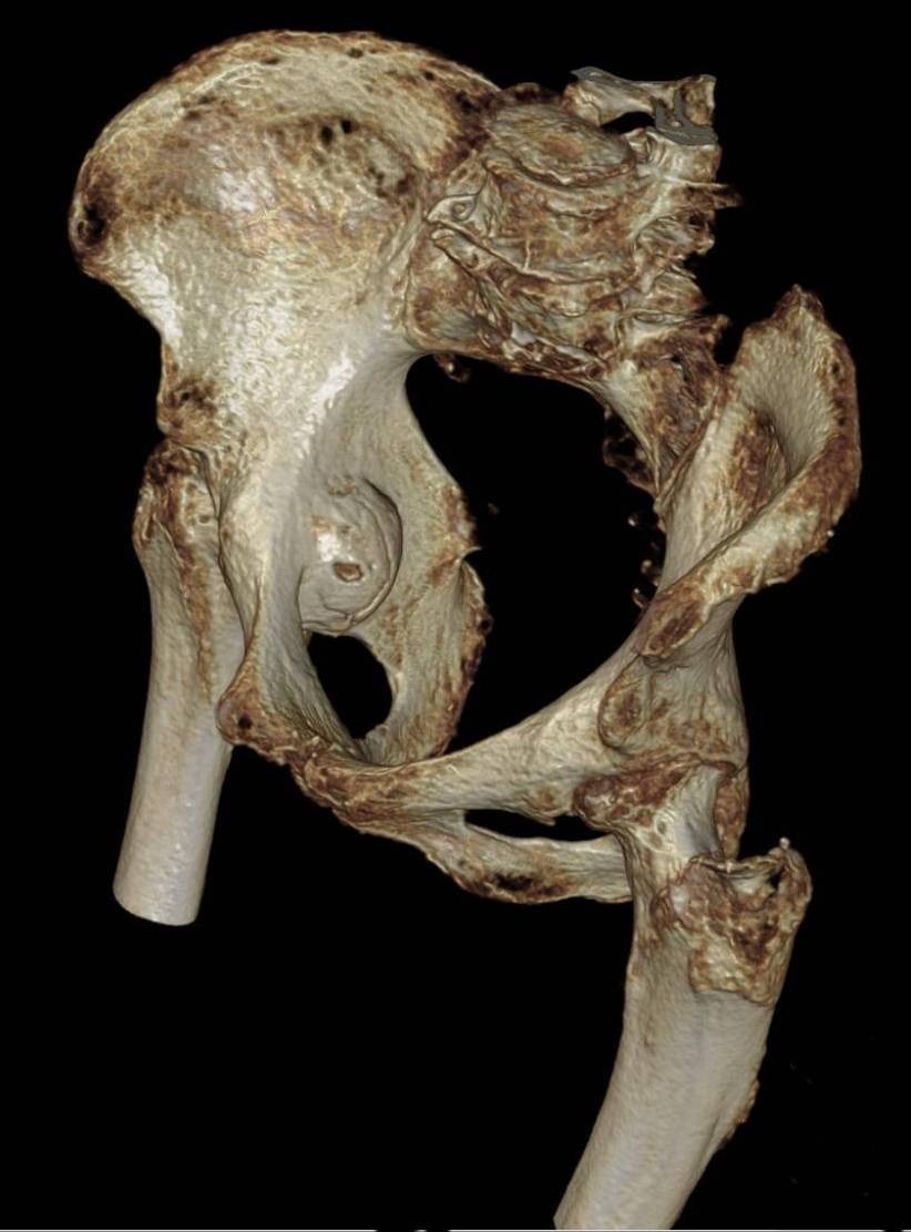 Figure 13. A 3D CT reconstruction of an acetabular fracture with protrusio of the femoral head. Hellerhoff, CC BY-SA 4.0, via Wikimedia Commons.