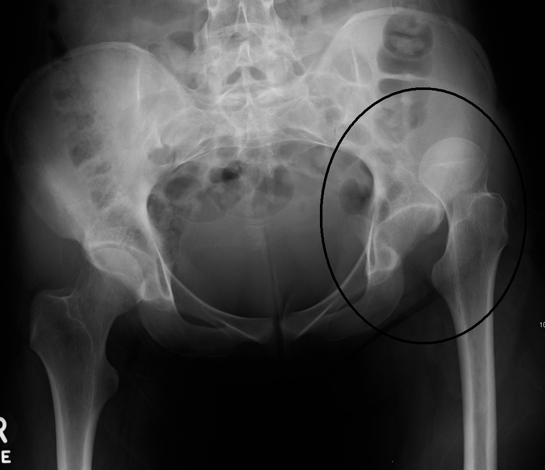 Figure 3. A posterior dislocation of the right hip on AP pelvis radiograph: the femoral head lies superolateral to the acetabulum. James Heilman, MD, CC BY-SA 3.0, via Wikimedia Commons.