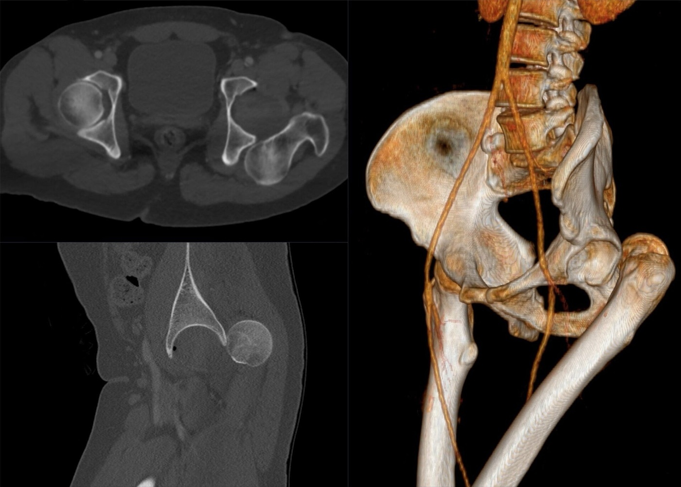 Figure 4. A traumatic posterior hip dislocation on CT (axial, sagittal, and 3D reconstruction). Hellerhoff, CC BY-SA 4.0, via Wikimedia Commons.