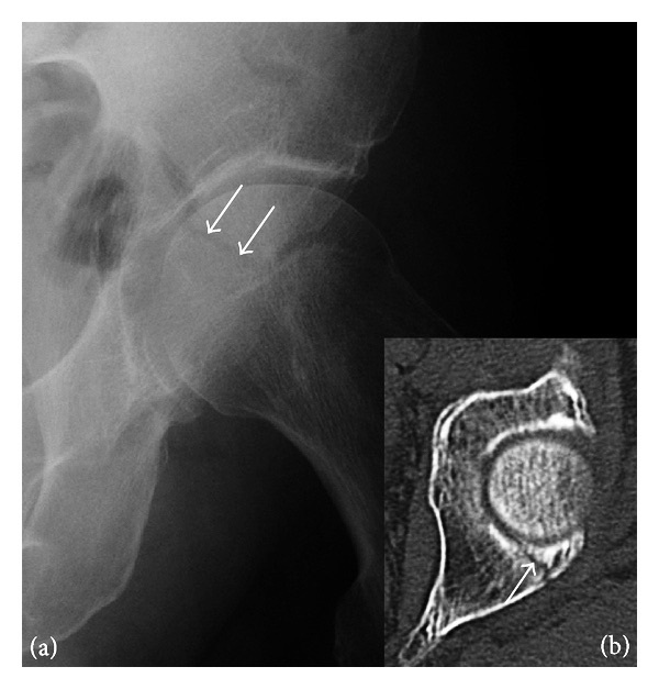 Figure 11. A subtle posterior acetabular wall fracture (radiograph with arrows; CT inset). Jarraya et al., CC BY 3.0, via Wikimedia Commons.