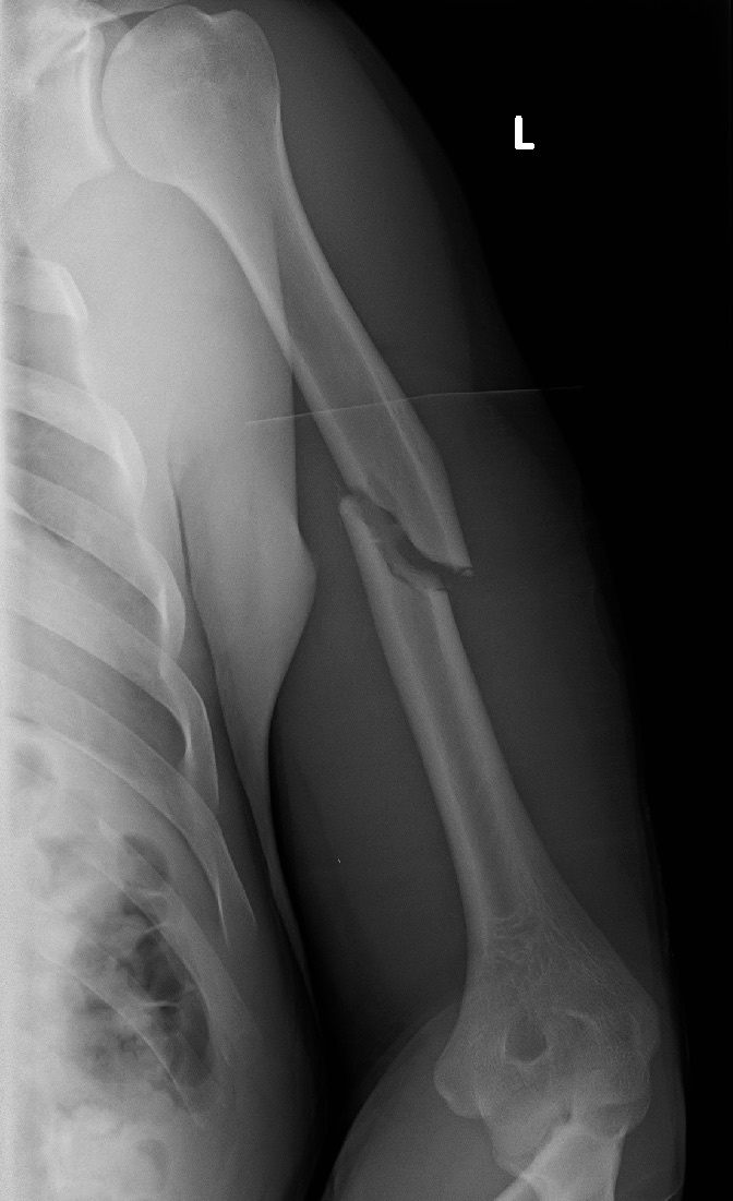 Figure 1. AP radiograph of a displaced fracture of the mid-shaft of the humerus. Source: James Heilman, MD, via Wikimedia Commons, CC BY-SA 4.0.