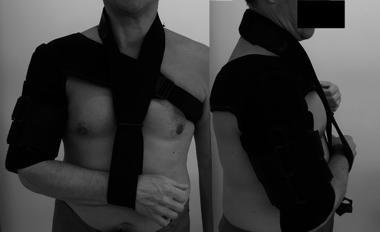 Figure 8. A functional (Sarmiento-type) humeral brace: a two-part sleeve that splints the fracture by hydraulic soft-tissue compression while allowing joint motion. From Arealis et al. (2021), Cureus 13(5):e14852, PMC8174392, CC BY 4.0.