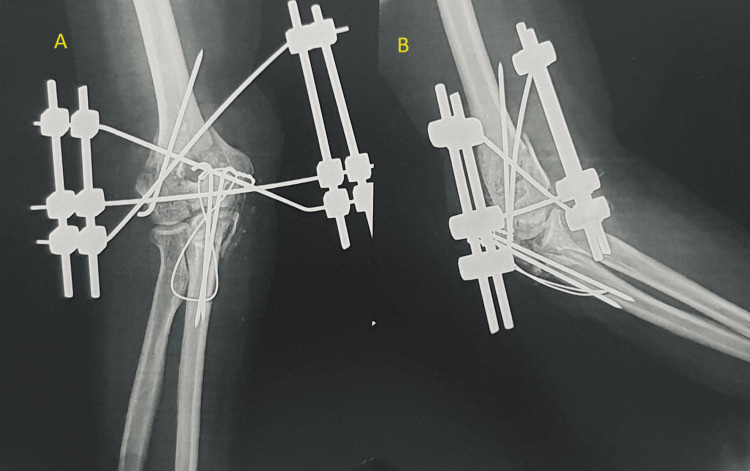 Figure 12. An external fixator applied to the humerus/elbow for an open fracture, used for damage control and contaminated injuries. From Phalak et al. (2024), Cureus 16(8):e66460, PMC11380531, CC BY 4.0.