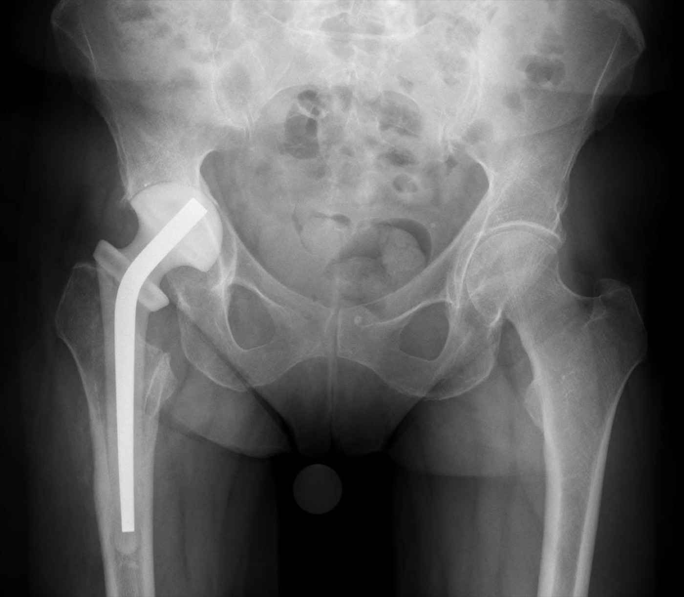 Figure 15. AP pelvis radiograph showing an antibiotic-loaded cement hip spacer placed for periprosthetic joint infection during a staged (two-stage) exchange. Source: Hellerhoff, via Wikimedia Commons, CC BY-SA 4.0.