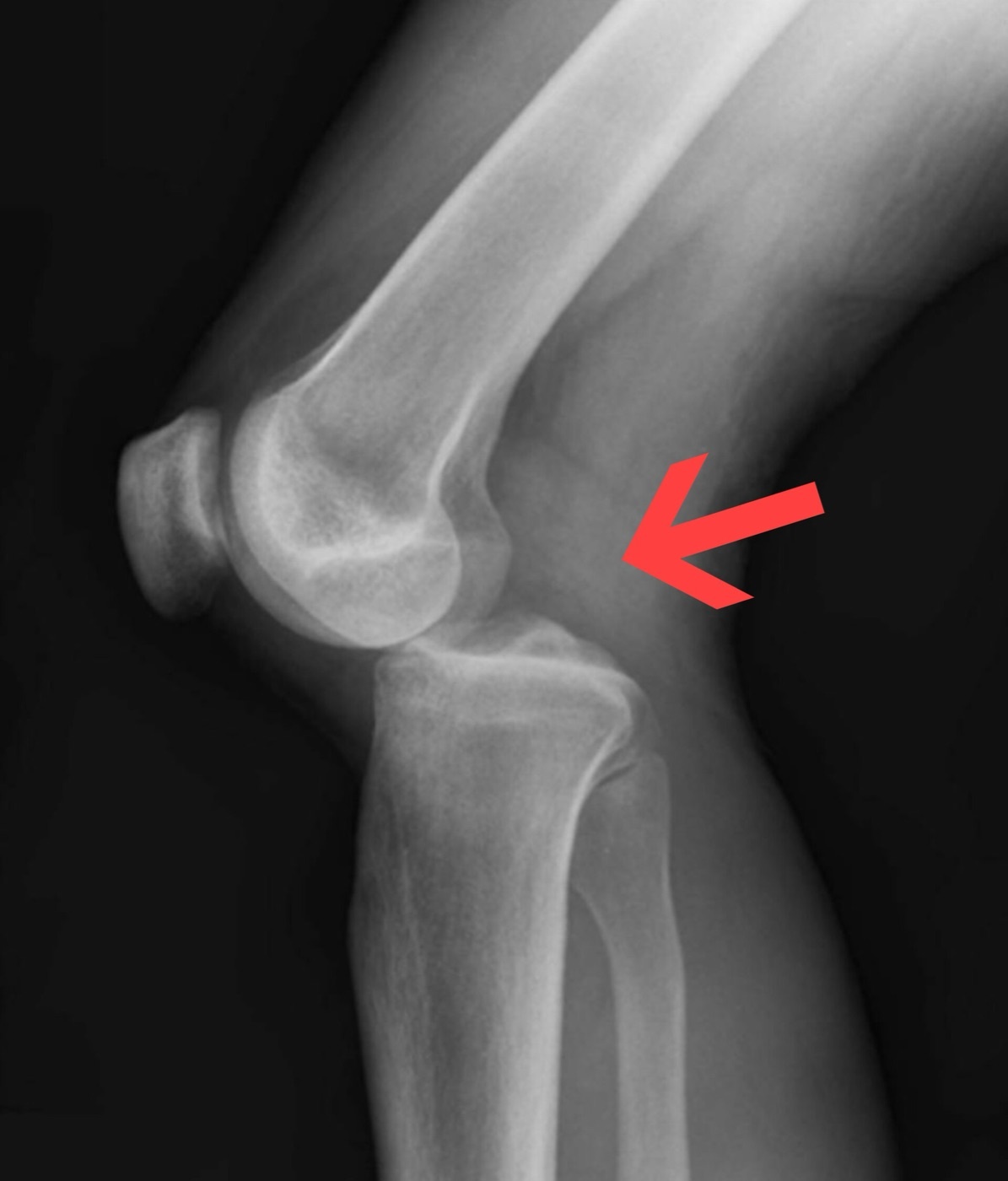 Figure 3. Lateral radiograph demonstrating a posterior tibiofemoral (knee) dislocation, the tibia displaced posteriorly (arrow). Image by Duprey & Lin, CC BY 4.0, via Wikimedia Commons.