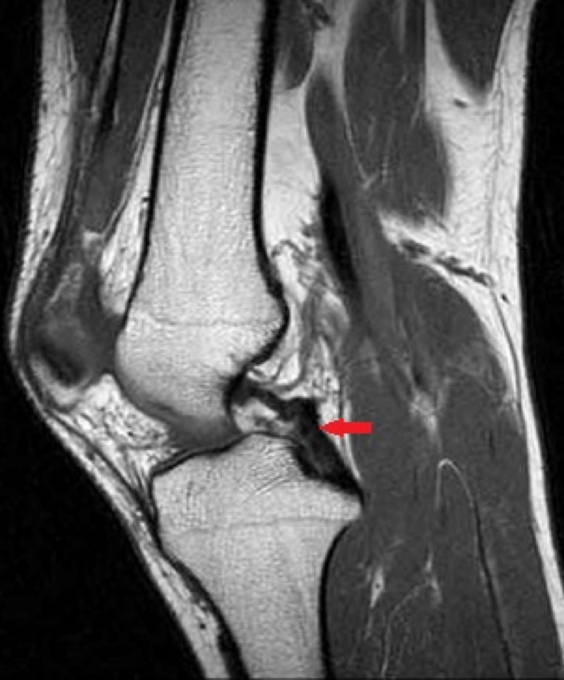 Figure 12. Sagittal T1 knee MRI showing the posterior cruciate ligament (arrow). Image by SCiardullo, CC BY-SA 4.0, via Wikimedia Commons.