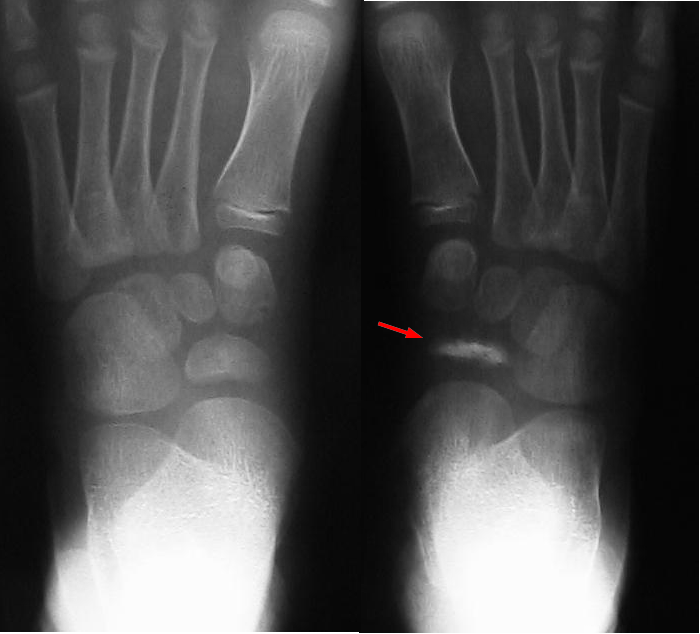 Both feet of a child with Köhler disease: the right tarsal navicular (red arrow) is sclerotic, flattened and fragmented compared with the normal rounded navicular on the left. (Kinderradiologie Olgahospital, Klinikum Stuttgart, Wikimedia Commons; CC BY-SA 4.0.)